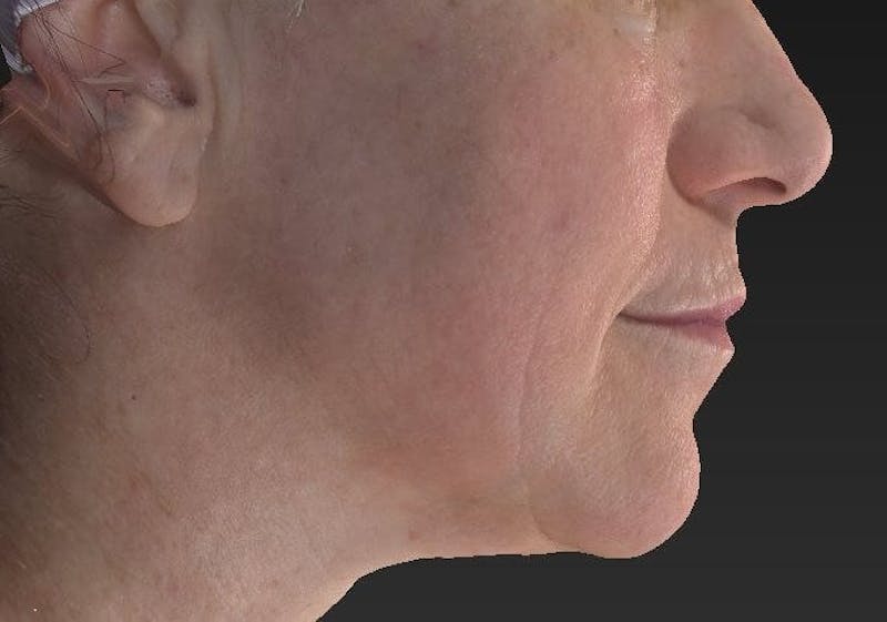 Laser Skin Resurfacing Before & After Gallery - Patient 119279612 - Image 2