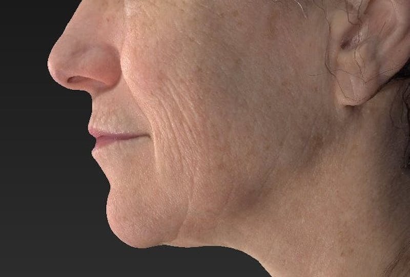 Laser Skin Resurfacing Before & After Gallery - Patient 119279612 - Image 3
