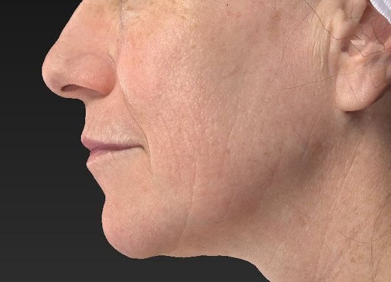 Laser Skin Resurfacing Before & After Gallery - Patient 119279612 - Image 4