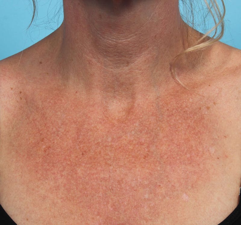 IPL and Pigment Therapy Before & After Gallery - Patient 119279614 - Image 1