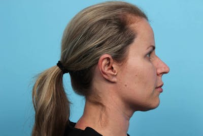 Laser Skin Resurfacing Before & After Gallery - Patient 119279615 - Image 1