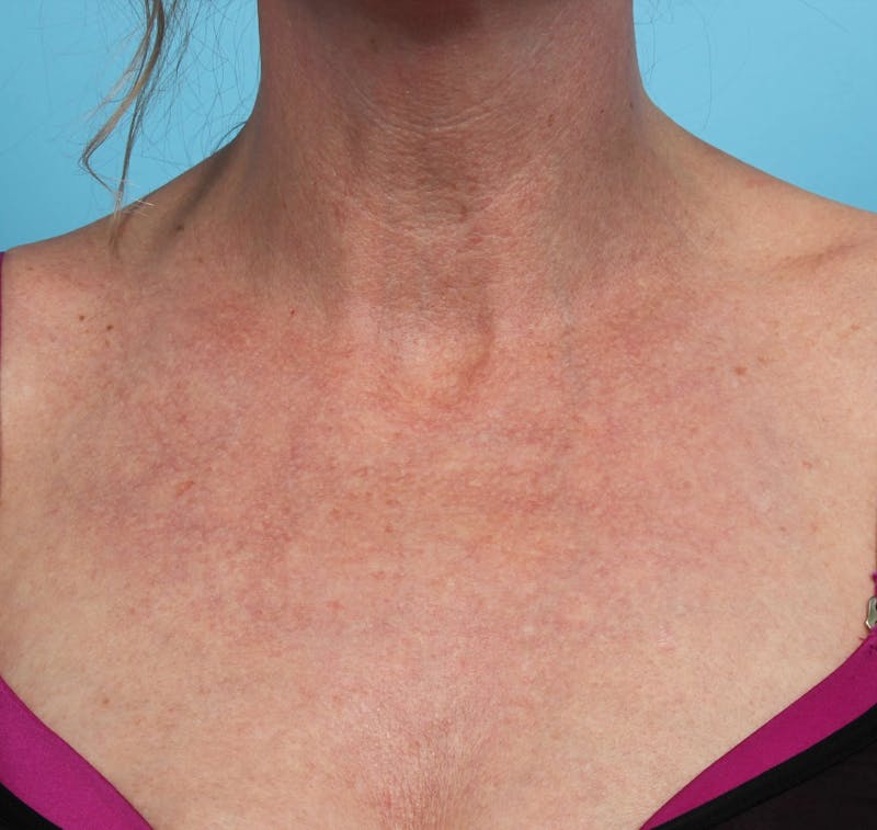 IPL and Pigment Therapy Before & After Gallery - Patient 119279614 - Image 2