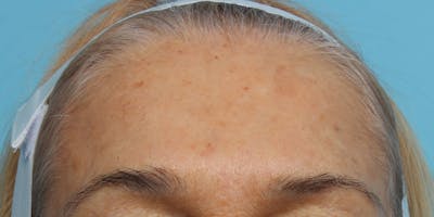 IPL and Pigment Therapy Before & After Gallery - Patient 119279664 - Image 1