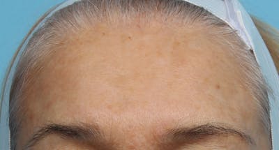 IPL and Pigment Therapy Before & After Gallery - Patient 119279664 - Image 2