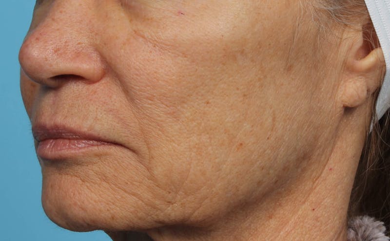 IPL and Pigment Therapy Before & After Gallery - Patient 119279664 - Image 3