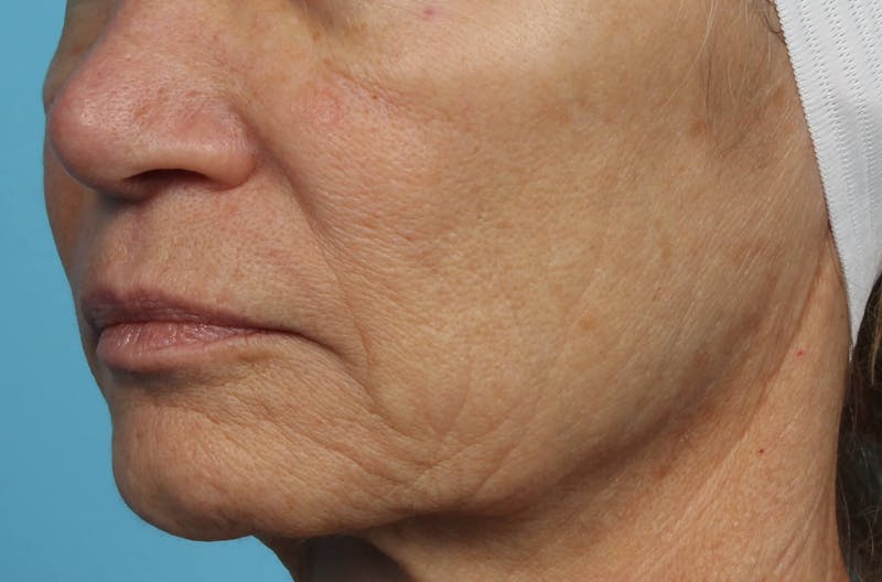 IPL and Pigment Therapy Before & After Gallery - Patient 119279664 - Image 4