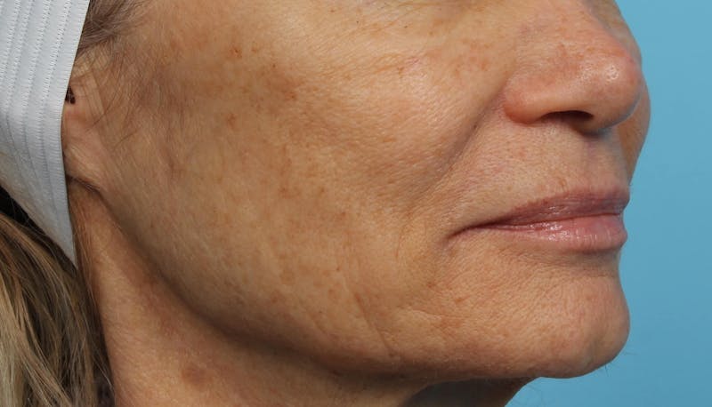 IPL and Pigment Therapy Before & After Gallery - Patient 119279664 - Image 5