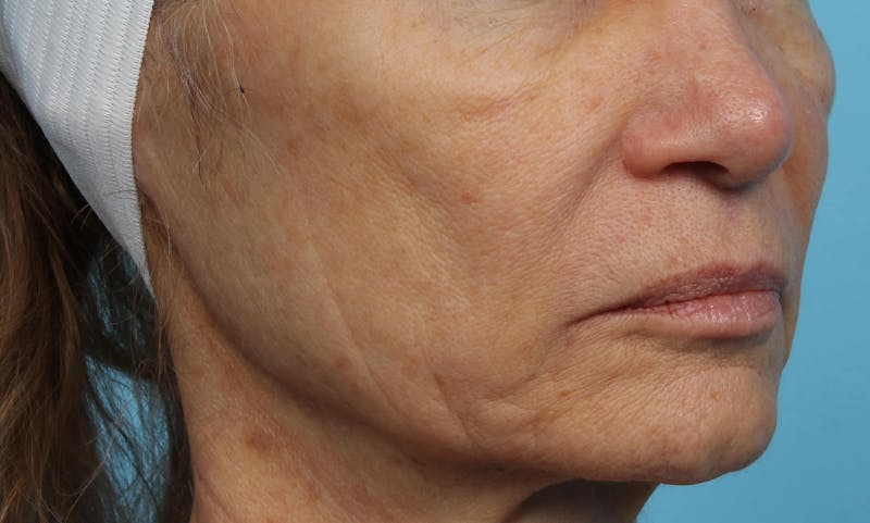 IPL and Pigment Therapy Before & After Gallery - Patient 119279664 - Image 6