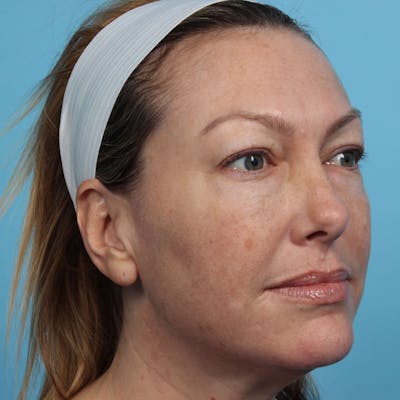 IPL and Pigment Therapy Before & After Gallery - Patient 119279734 - Image 1