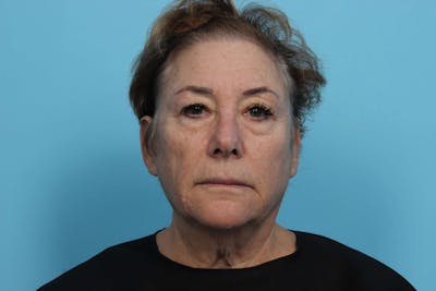 Restylane<sup>®</sup> Before & After Gallery - Patient 119279679 - Image 2