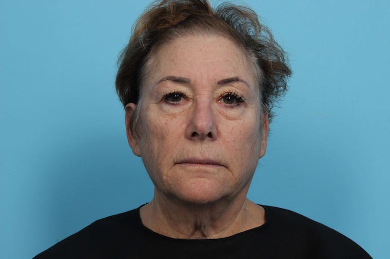 Restylane<sup>®</sup> Before & After Gallery - Patient 119279679 - Image 2