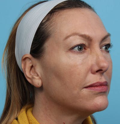 IPL and Pigment Therapy Before & After Gallery - Patient 119279734 - Image 2
