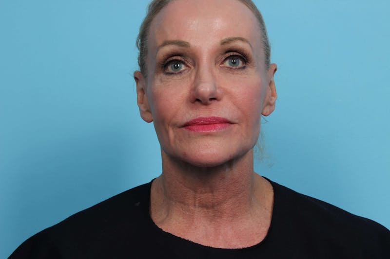 Laser Skin Resurfacing Before & After Gallery - Patient 119279712 - Image 1