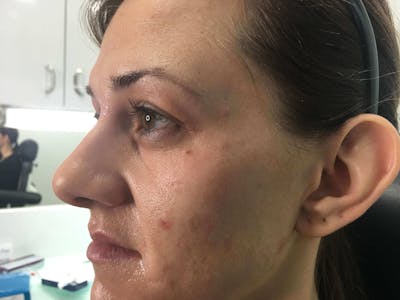 Restylane<sup>®</sup> Before & After Gallery - Patient 119279713 - Image 1