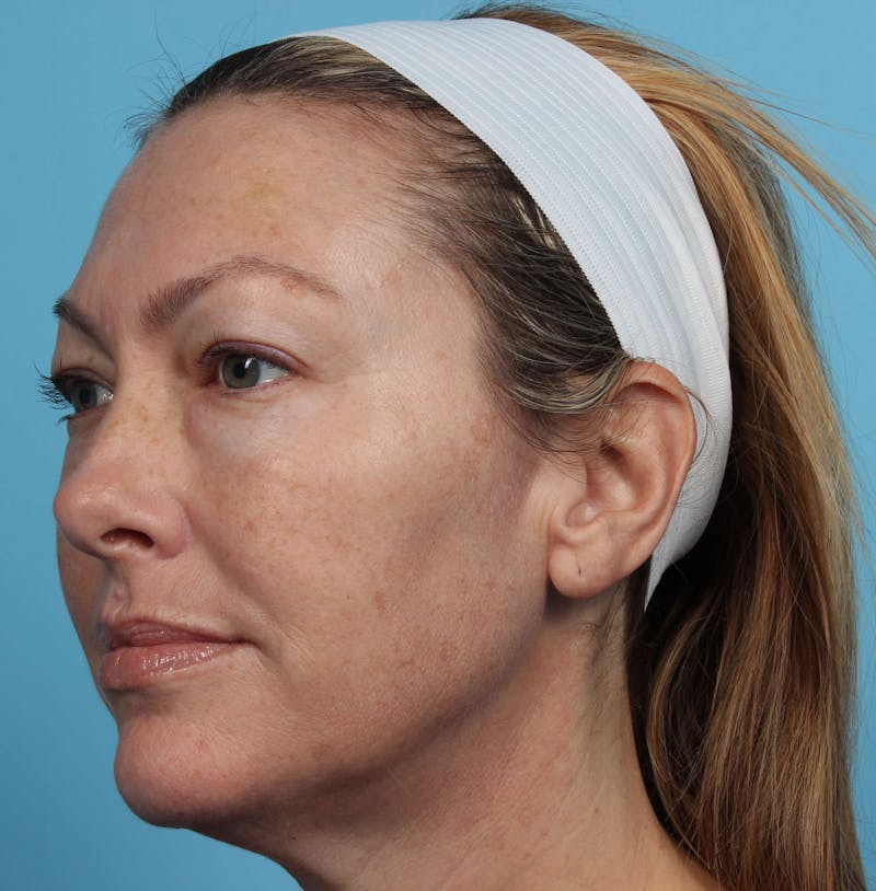 IPL and Pigment Therapy Before & After Gallery - Patient 119279734 - Image 3