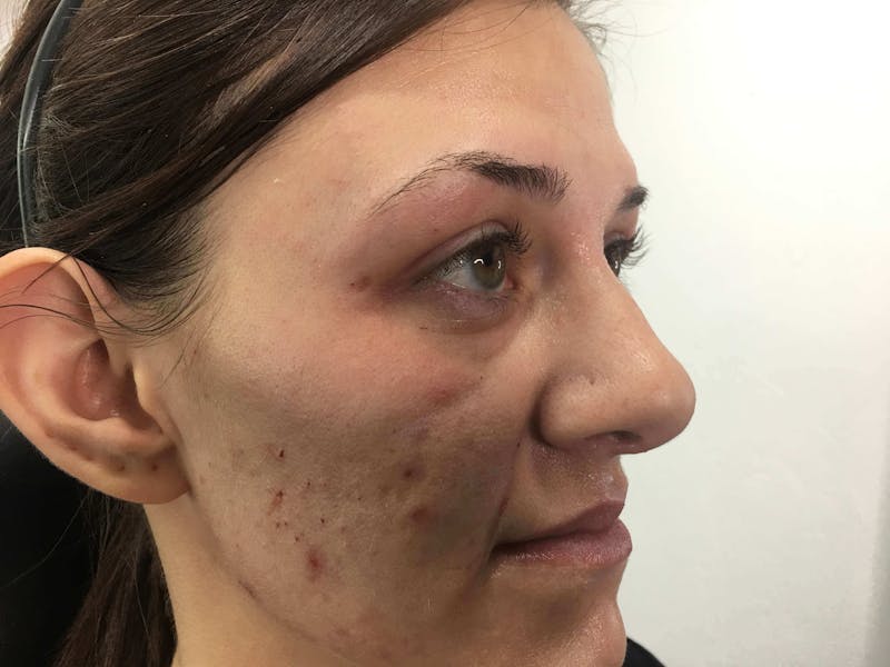 Restylane<sup>®</sup> Before & After Gallery - Patient 119279713 - Image 2