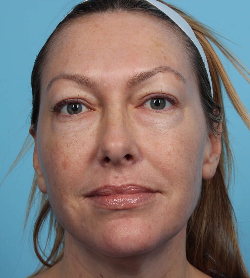 IPL and Pigment Therapy Before & After Gallery - Patient 119279734 - Image 5