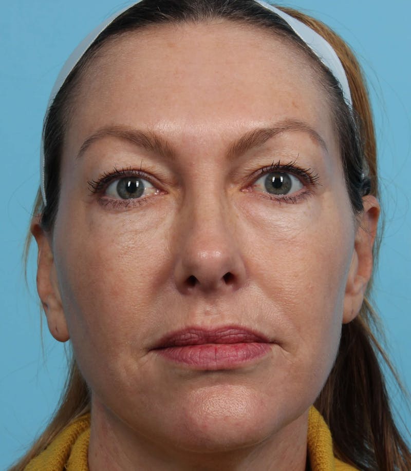 IPL and Pigment Therapy Before & After Gallery - Patient 119279734 - Image 6