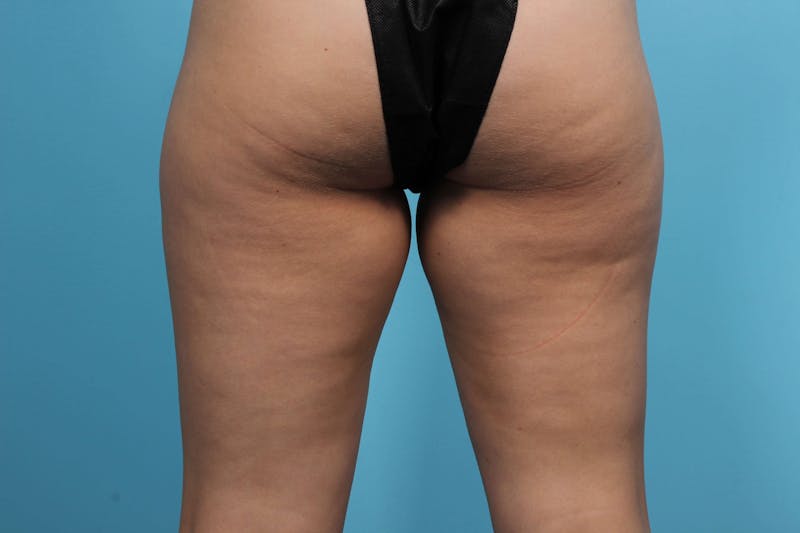 CoolSculpting Before & After Gallery - Patient 119279826 - Image 1