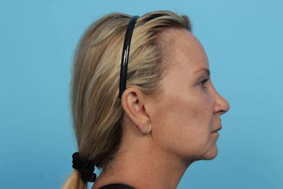 Laser Skin Resurfacing Before & After Gallery - Patient 119279735 - Image 2