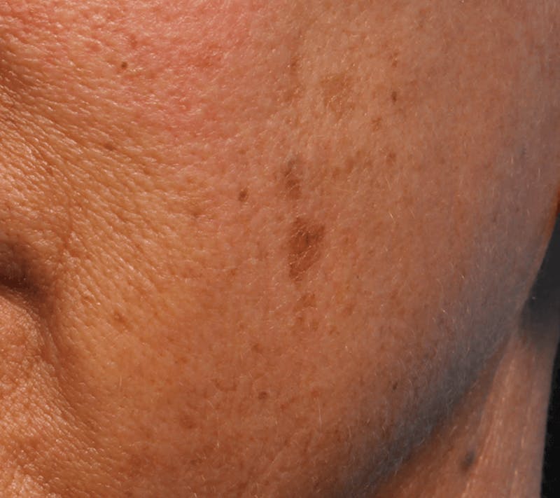 IPL and Pigment Therapy Before & After Gallery - Patient 119279805 - Image 1
