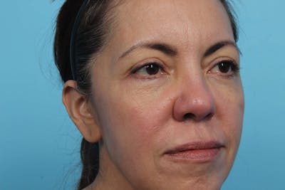 Laser Skin Resurfacing Before & After Gallery - Patient 119279825 - Image 1