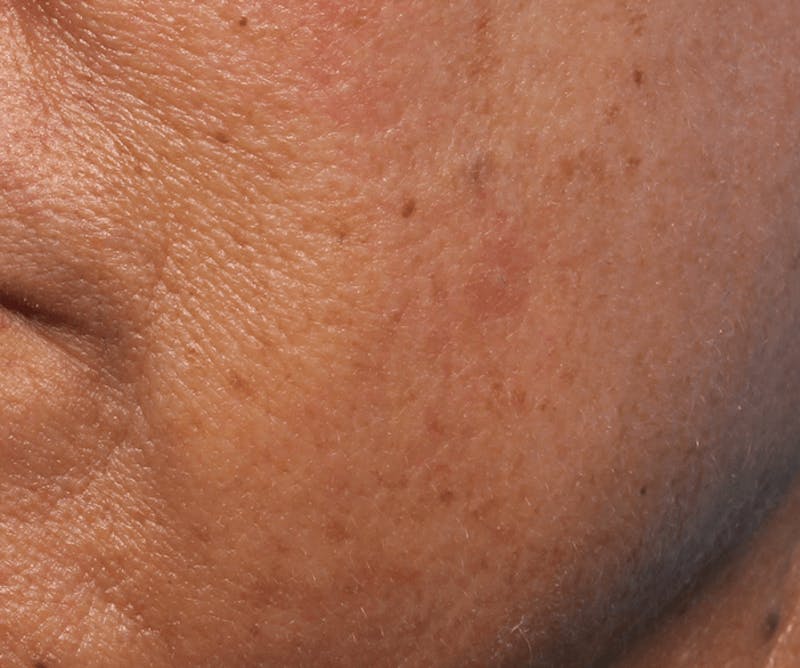 IPL and Pigment Therapy Before & After Gallery - Patient 119279805 - Image 2