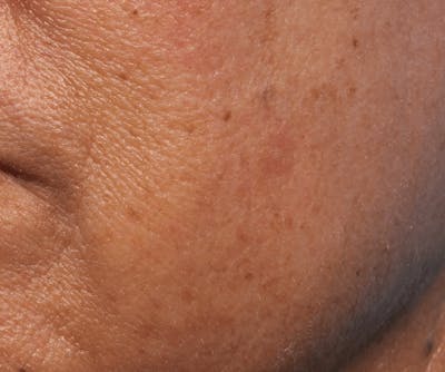 IPL and Pigment Therapy Before & After Gallery - Patient 119279805 - Image 2