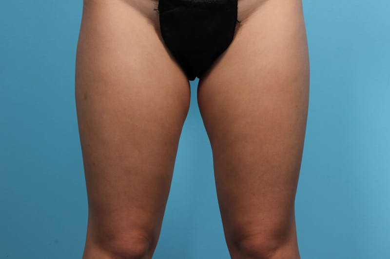 CoolSculpting Before & After Gallery - Patient 119279826 - Image 3