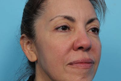 Laser Skin Resurfacing Before & After Gallery - Patient 119279825 - Image 2