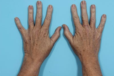 IPL and Pigment Therapy Before & After Gallery - Patient 119279859 - Image 1