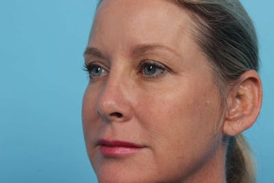 Laser Skin Resurfacing Before & After Gallery - Patient 119279873 - Image 1