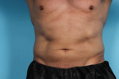 CoolSculpting Before & After Gallery - Patient 119279934 - Image 1