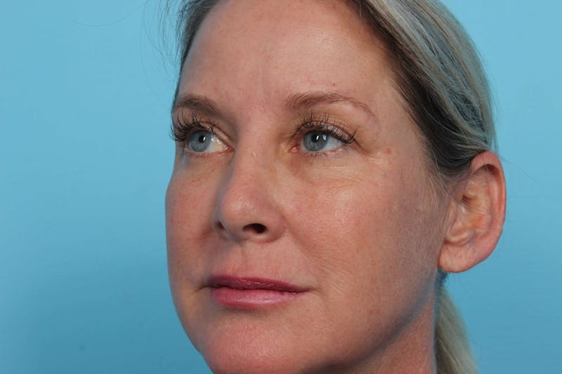 Laser Skin Resurfacing Before & After Gallery - Patient 119279873 - Image 2