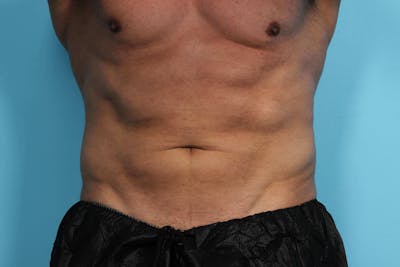 CoolSculpting Before & After Gallery - Patient 119279934 - Image 2