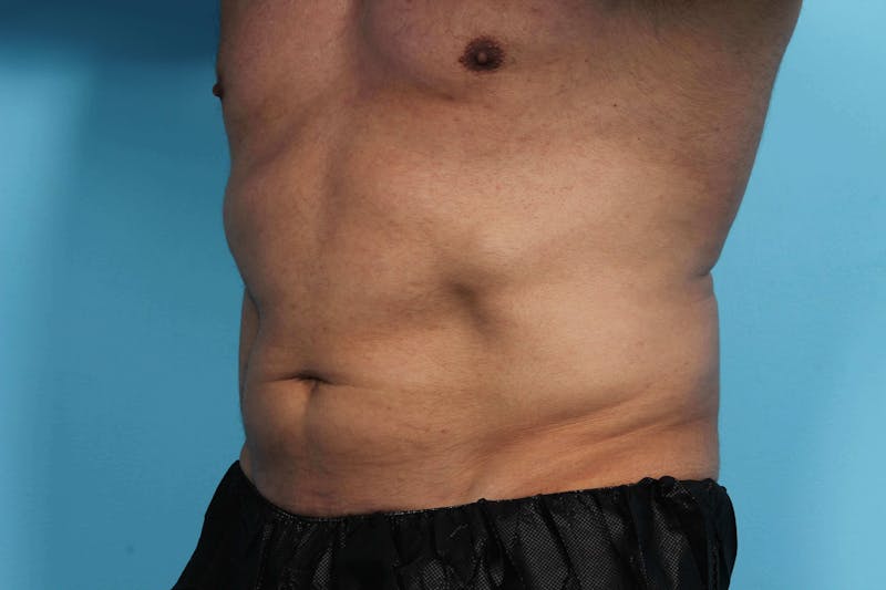 CoolSculpting Before & After Gallery - Patient 119279934 - Image 3