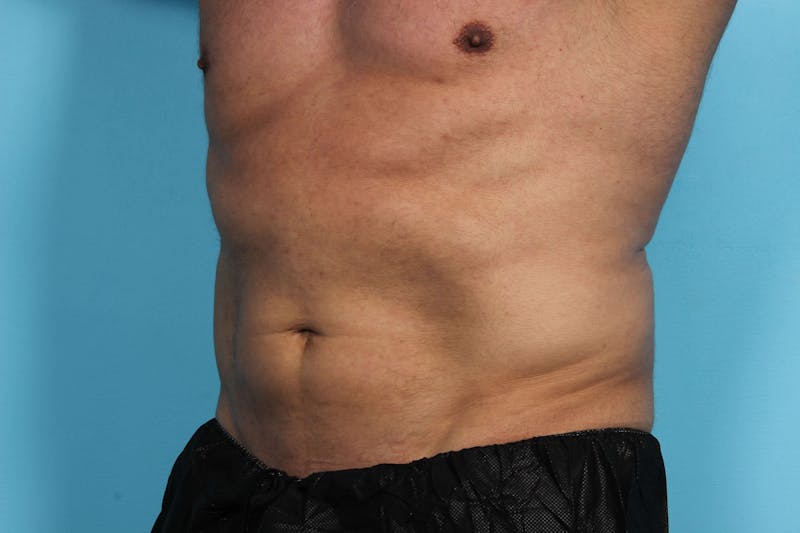 CoolSculpting Before & After Gallery - Patient 119279934 - Image 4