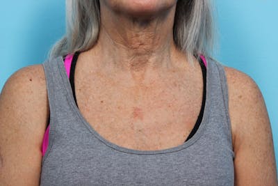 IPL and Pigment Therapy Before & After Gallery - Patient 119279981 - Image 1