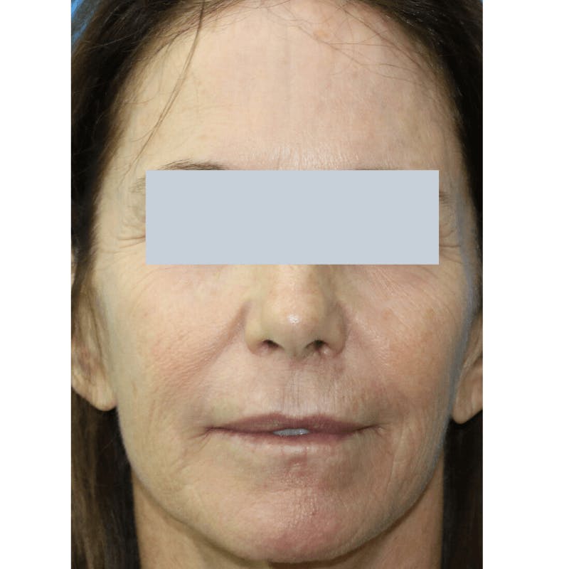 Laser Skin Resurfacing Before & After Gallery - Patient 119279980 - Image 1