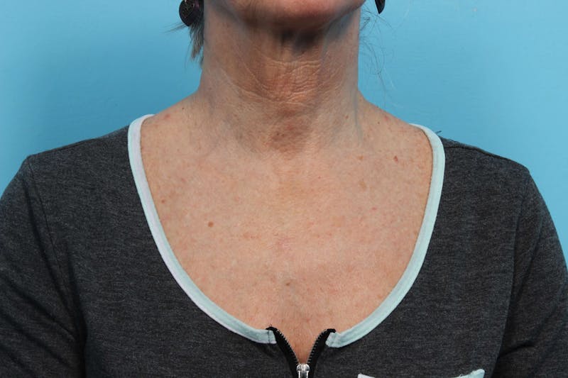 IPL and Pigment Therapy Before & After Gallery - Patient 119279981 - Image 2