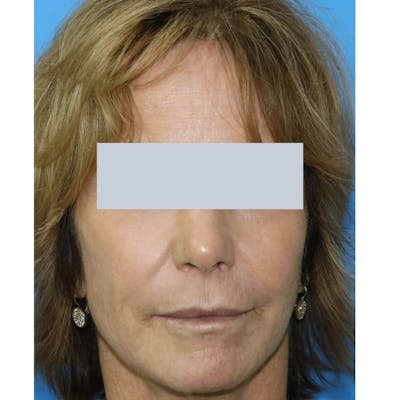 Laser Skin Resurfacing Before & After Gallery - Patient 119279980 - Image 2
