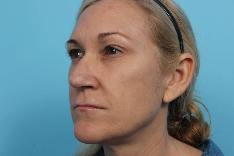 Laser Skin Resurfacing Before & After Gallery - Patient 119280082 - Image 5