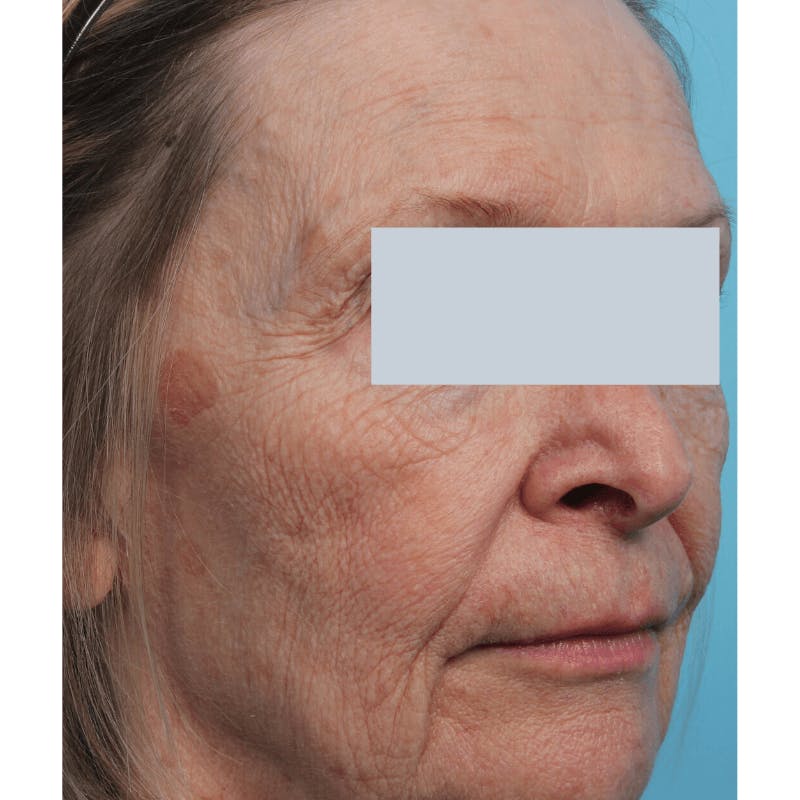 Laser Skin Resurfacing Before & After Gallery - Patient 119280166 - Image 1