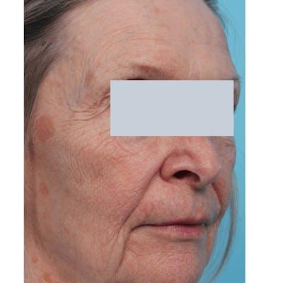 Laser Skin Resurfacing Before & After Gallery - Patient 119280166 - Image 2