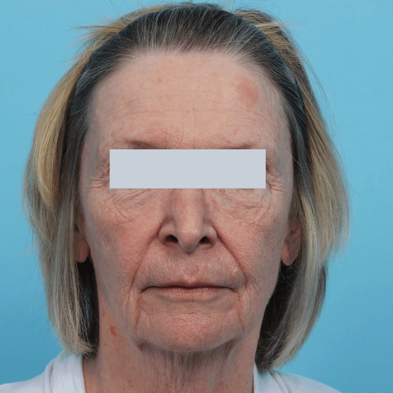 Laser Skin Resurfacing Before & After Gallery - Patient 119280166 - Image 4