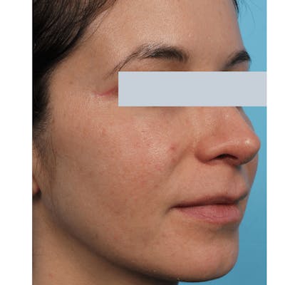 Laser Skin Resurfacing Before & After Gallery - Patient 119280278 - Image 1