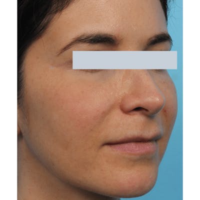 Laser Skin Resurfacing Before & After Gallery - Patient 119280278 - Image 2