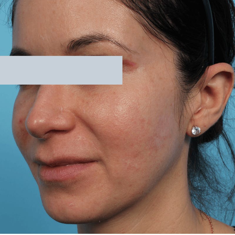 Laser Skin Resurfacing Before & After Gallery - Patient 119280278 - Image 3