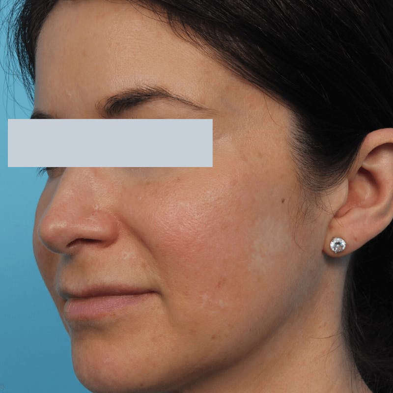 Laser Skin Resurfacing Before & After Gallery - Patient 119280278 - Image 4