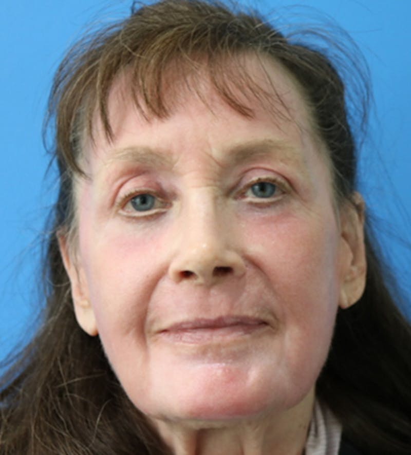 C02 Laser Resurfacing Before & After Gallery - Patient 133226064 - Image 2
